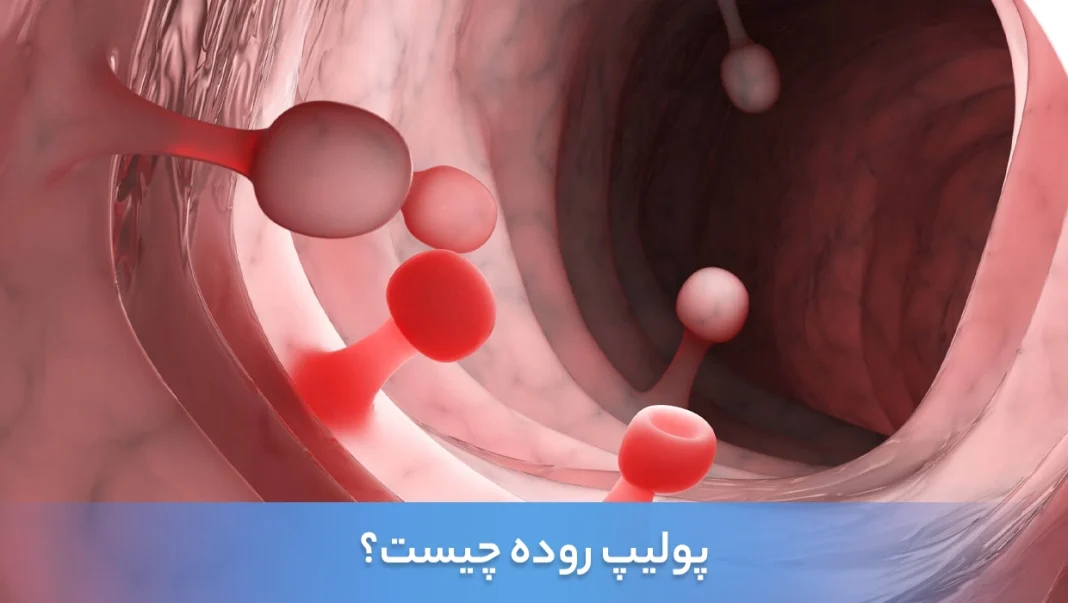 what-is-an-intestinal-polyp-1068x603