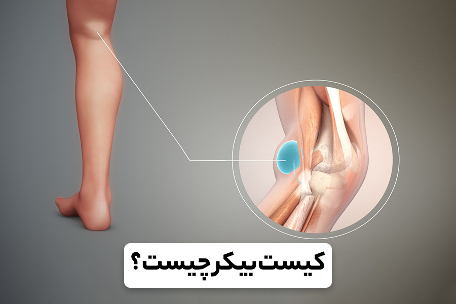 کیست بیکر زانو